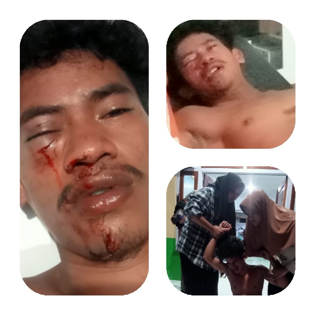 Merasa Tersinggung Karena Disebut Namanya Berulang Kali Oleh Bakri Warga Desa Bibinoi, Di Hajar Oleh Kades Beserta Kaur Hingga Babak Belur