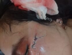 Luka Parah Dianiaya Suami, Ibu Rumah Tangga Di Tanggamus Laporan Polis